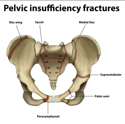 pelvic fracture